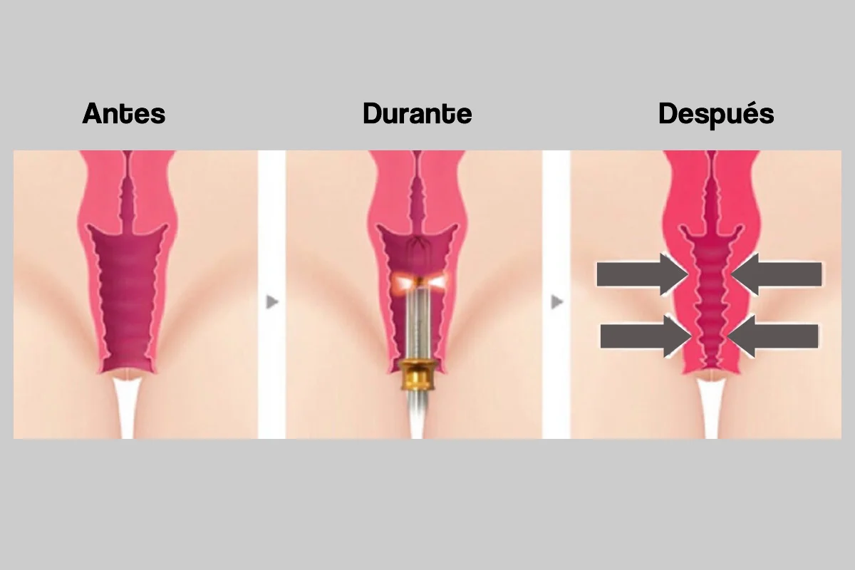 Tensado vaginal con láser Colombia
