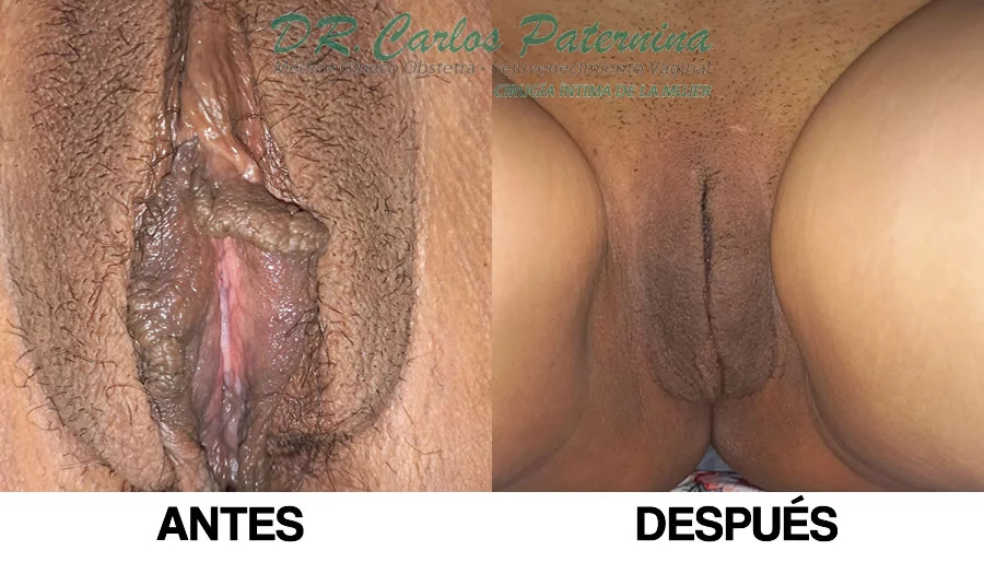 precio rejuvenecimiento vulvar fotos antes después