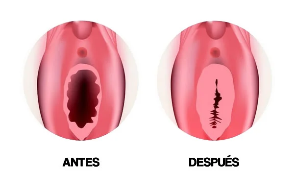 Himenoplastia cirugia intima mujer