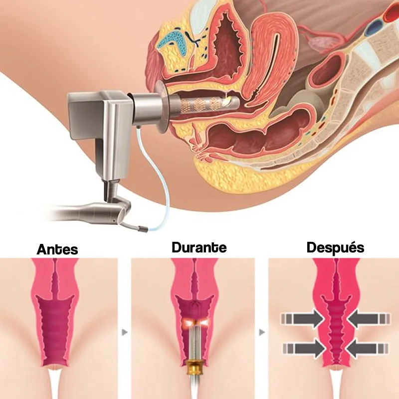Cirugía Rejuvenecimiento Vaginal intima tensado vaginal con laser