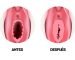 Himenoplastia cirugia intima mujer